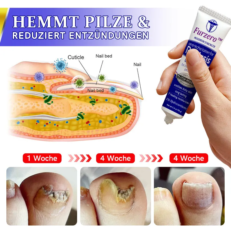 Furzero Psoriasis Anti-Juckreiz-Behandlungslotion
