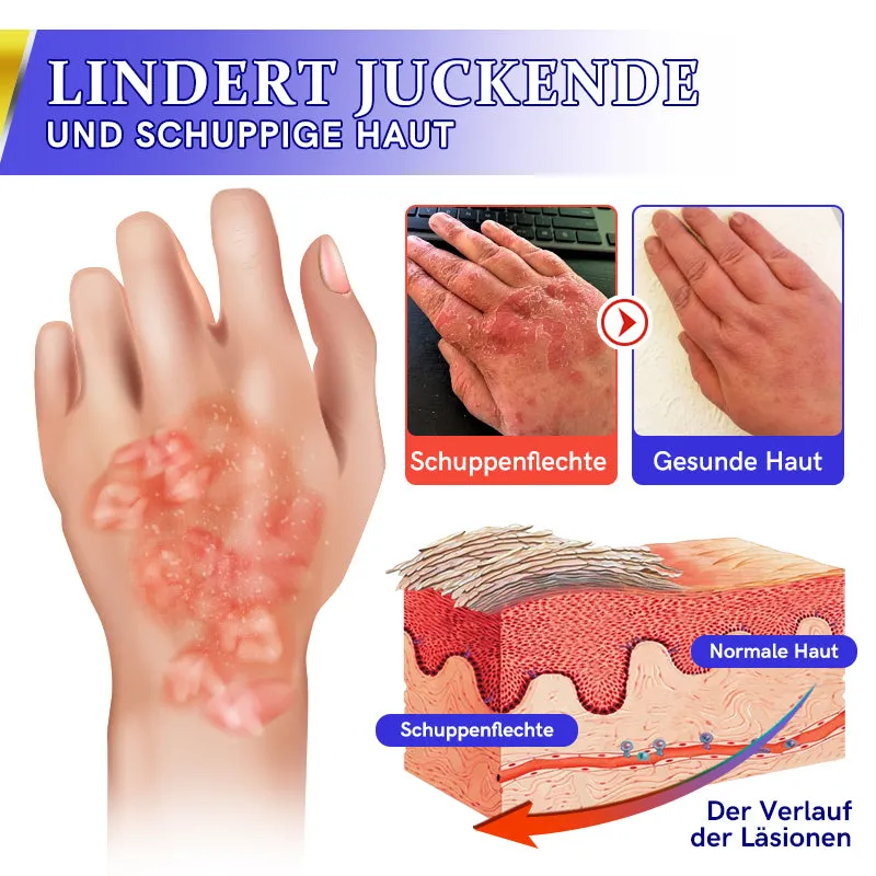 Furzero Psoriasis Anti-Juckreiz-Behandlungslotion